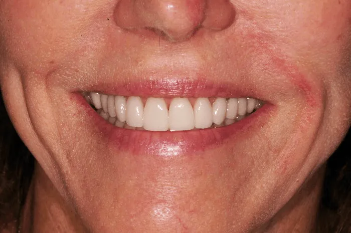 After dental transformation close up of a woman's smile