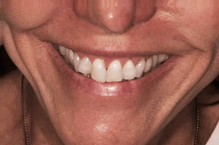 Before dental transformation close up of a woman's smile