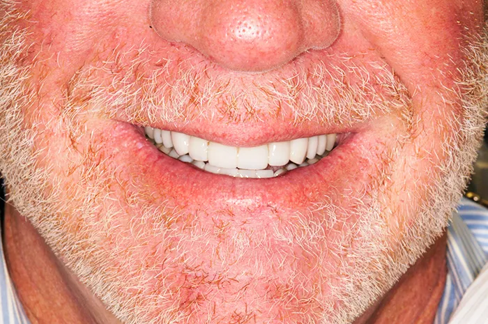 After dental transformation of a smiling patient