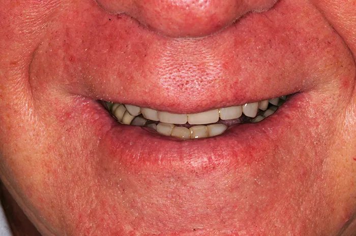 Before dental transformation close up of a smile