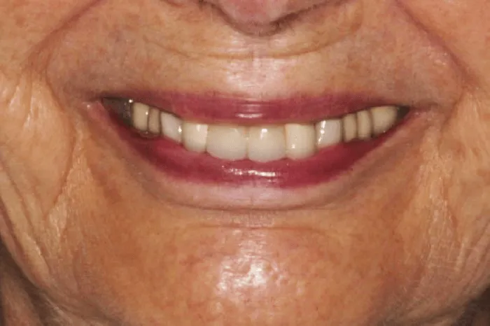 Before dental transformation close up of a woman's smile
